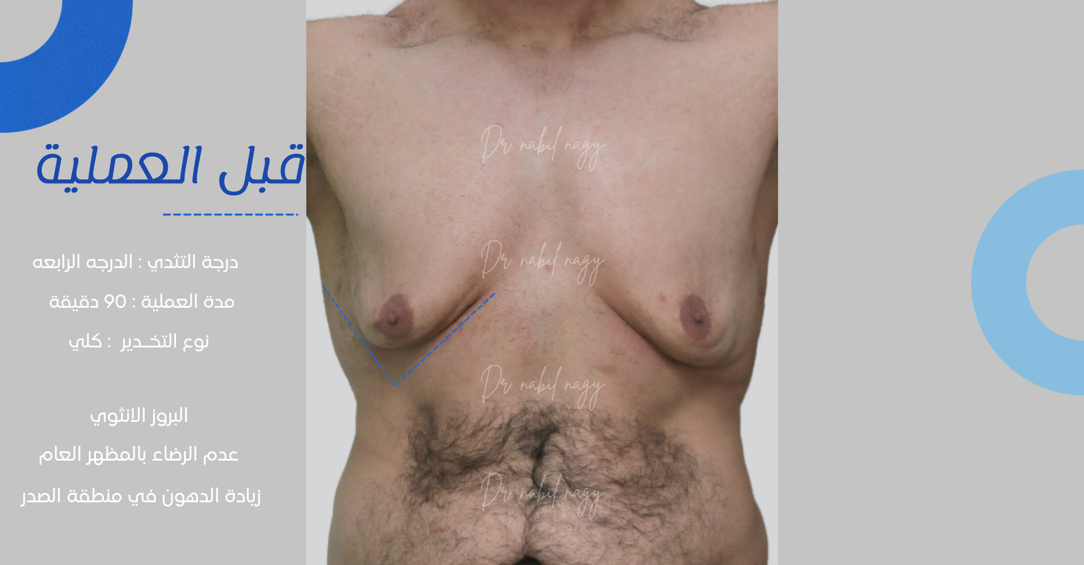 Before-حالة تثدي