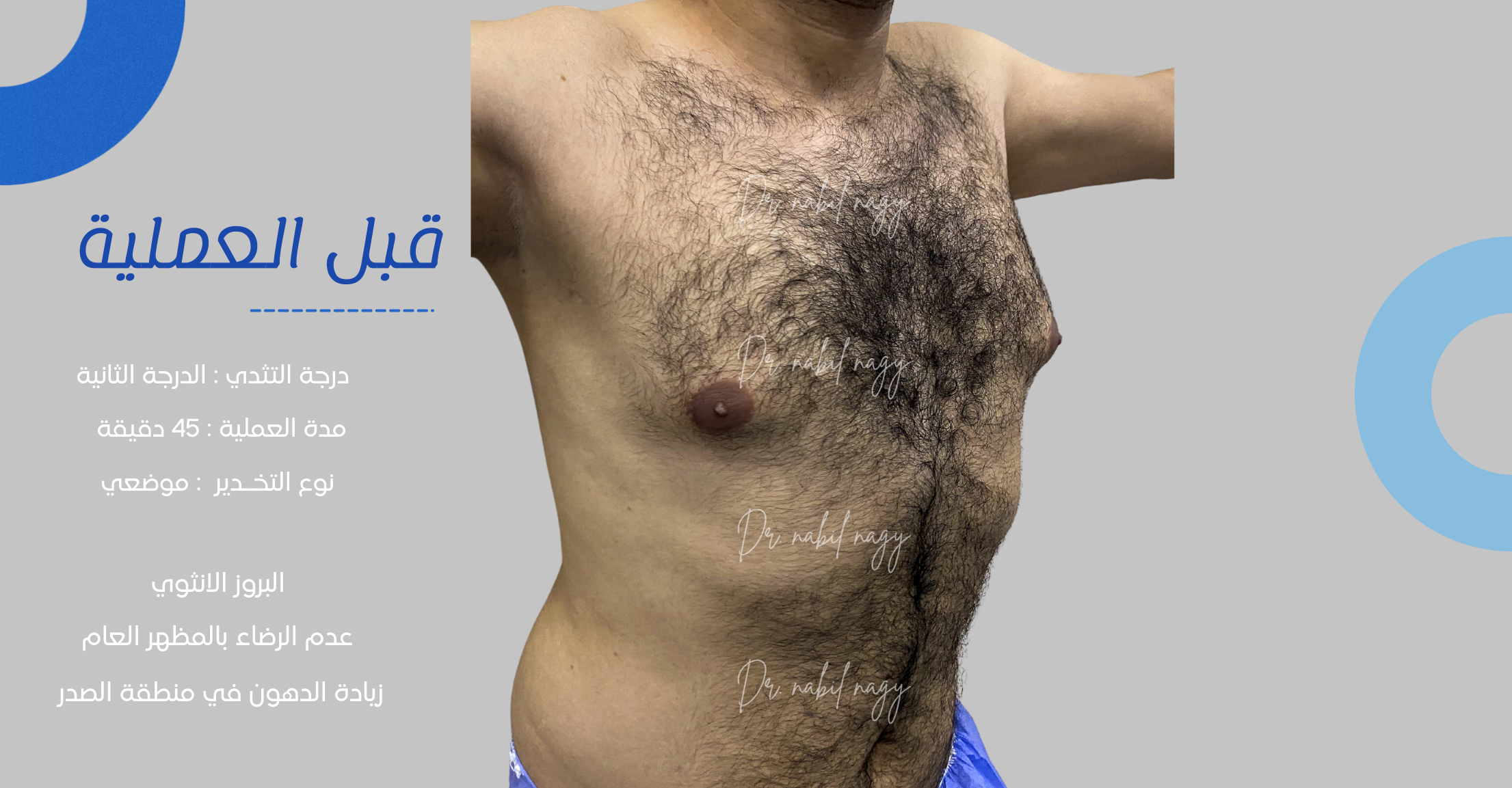 Before-حالة تثدي