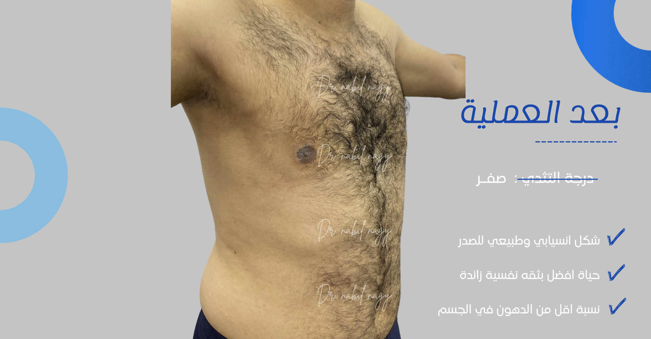 After-حالة تثدي
