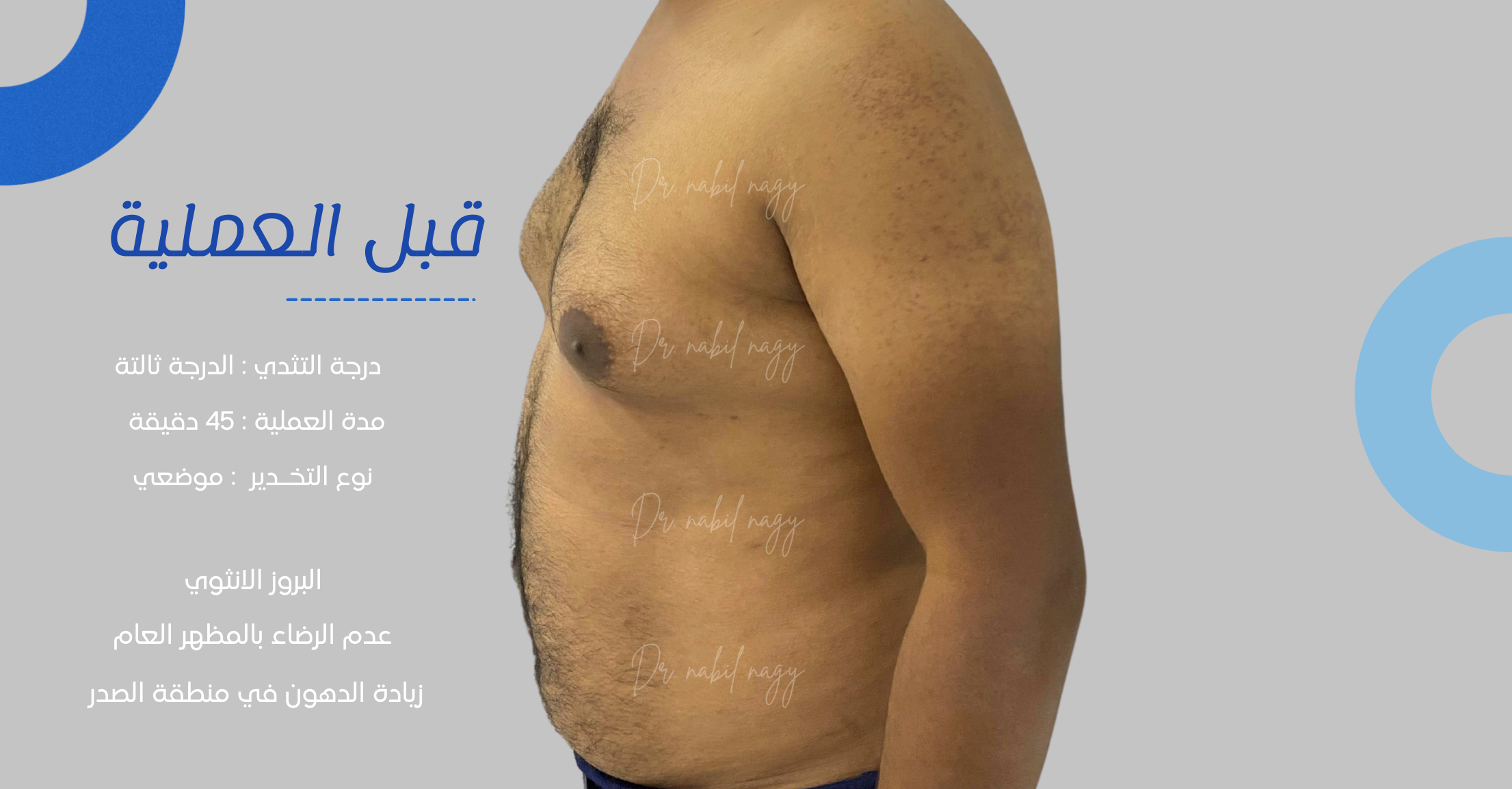 Before-حالة تثدي