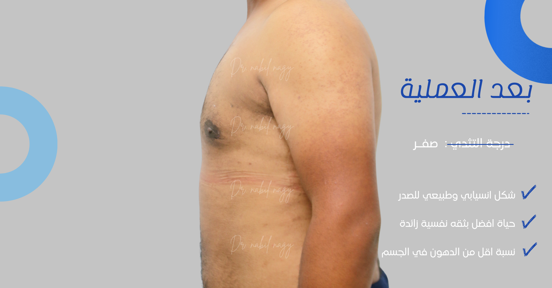 After-حالة تثدي