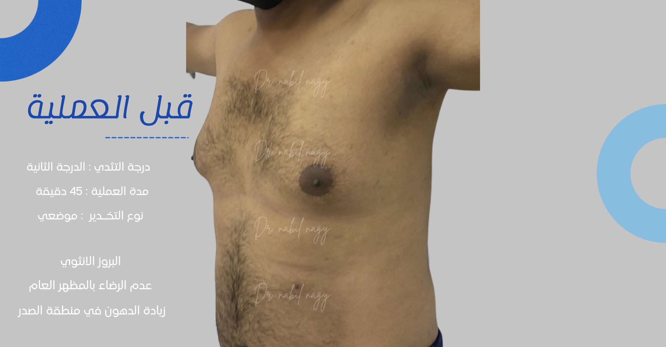 Before-حالة تثدي