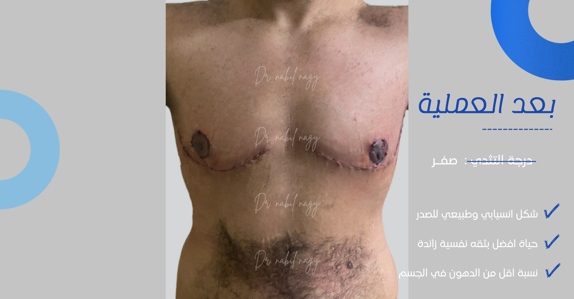 After-حالة تثدي