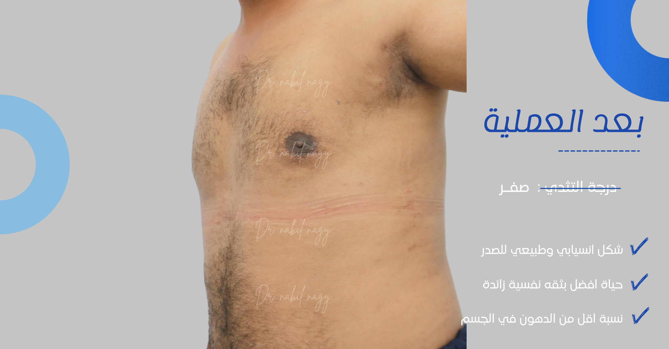 After-حالة تثدي