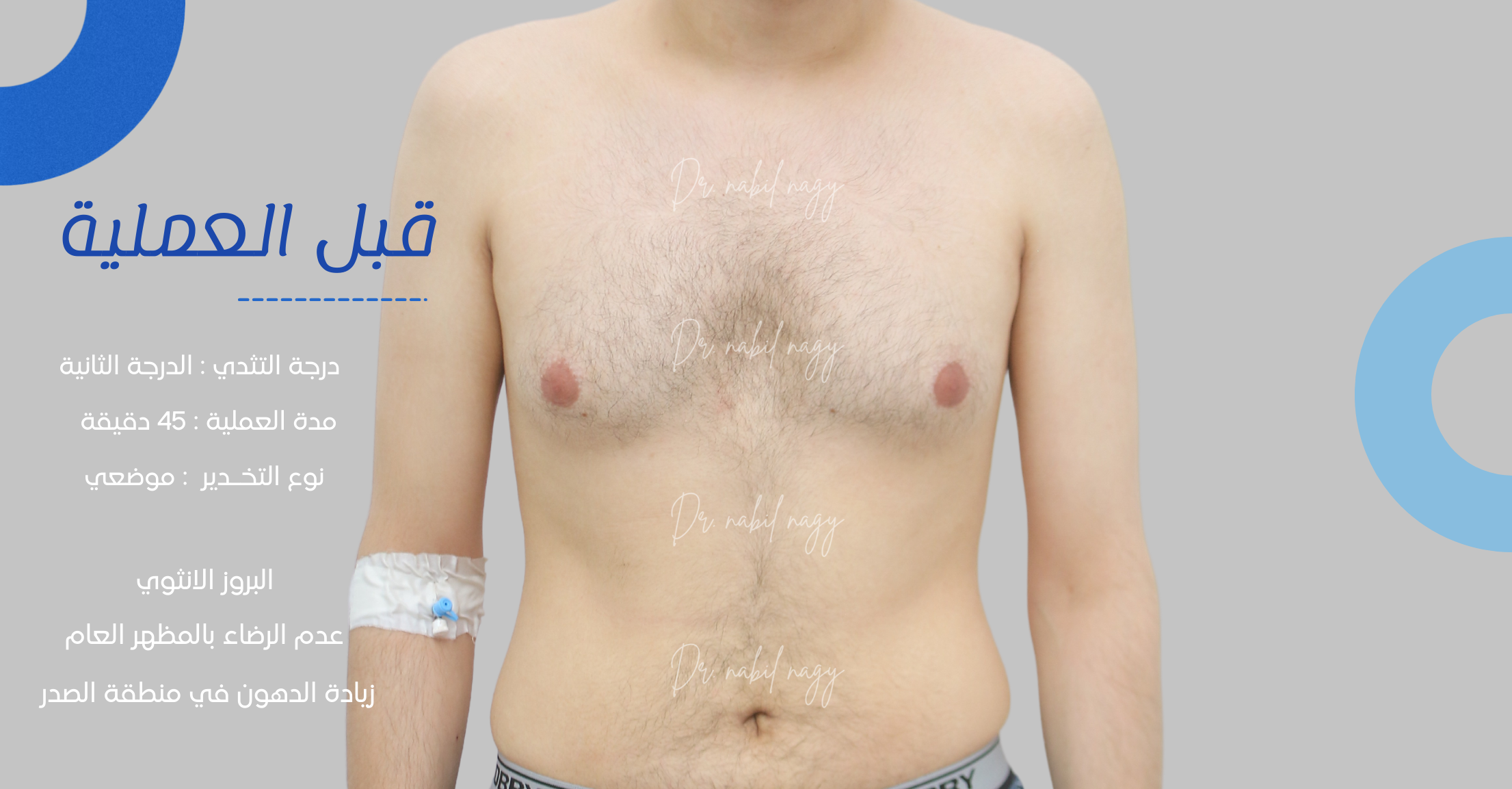 Before-حالة تثدي