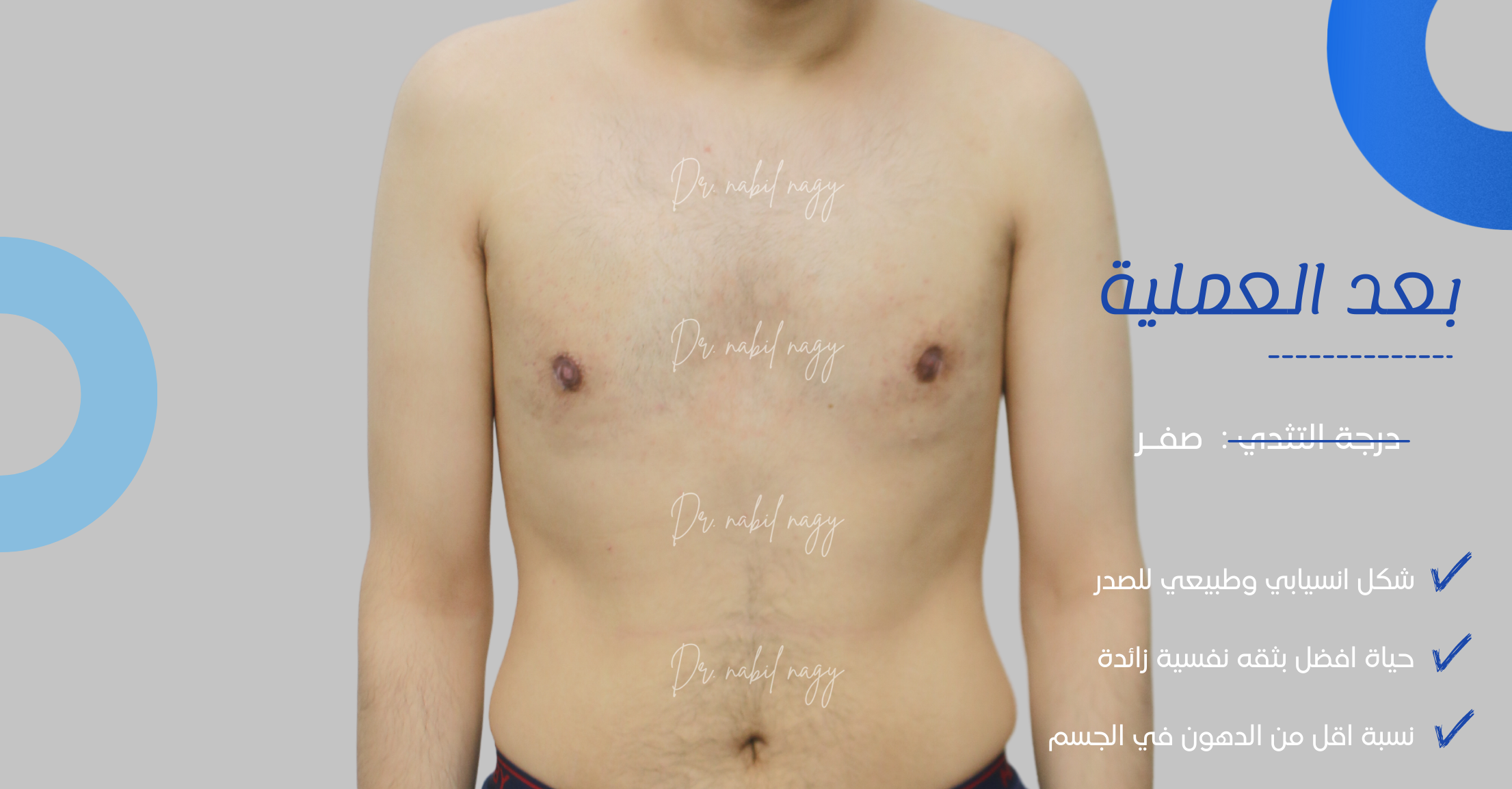 After-حالة تثدي