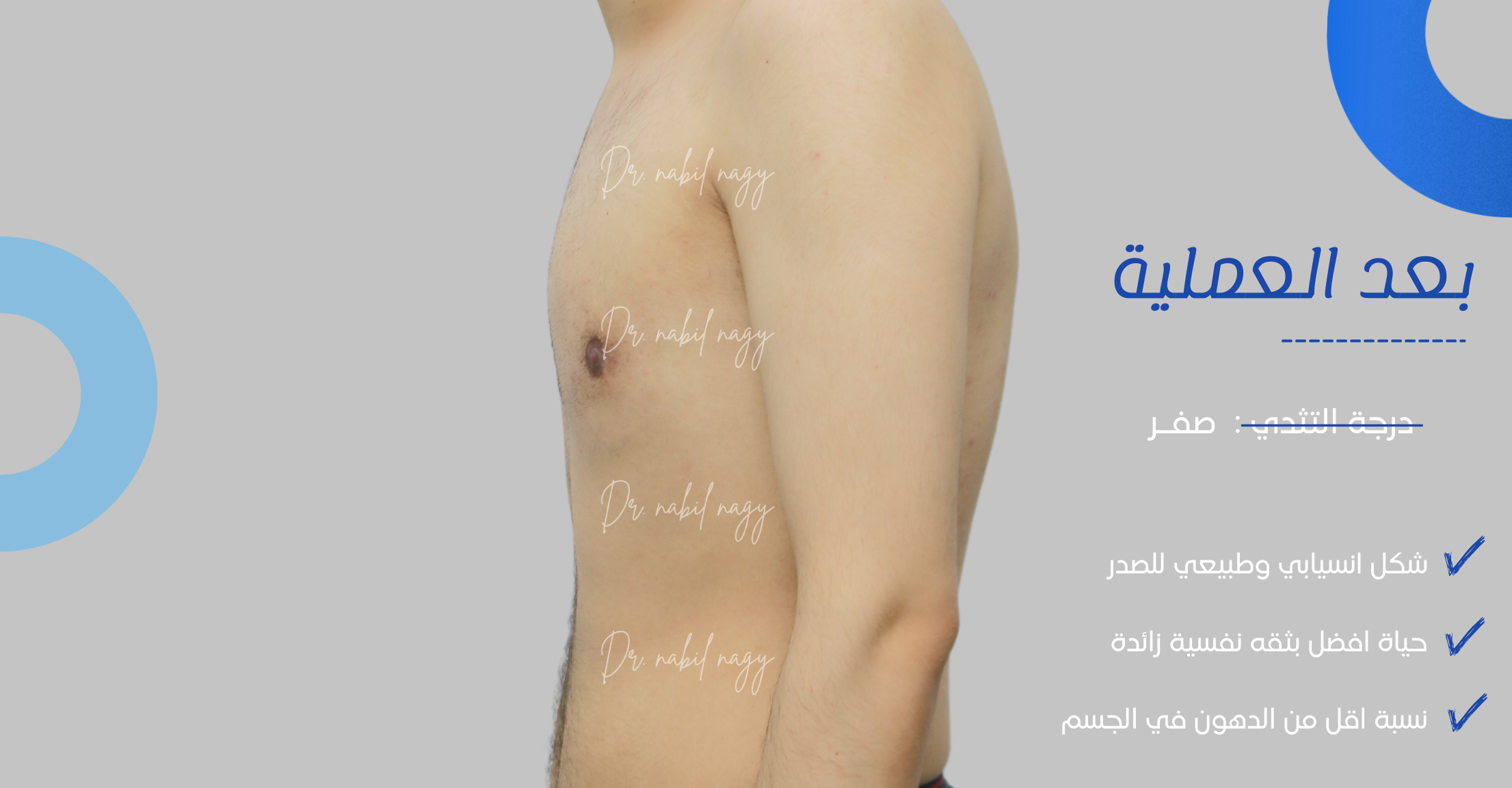 After-حالة تثدي
