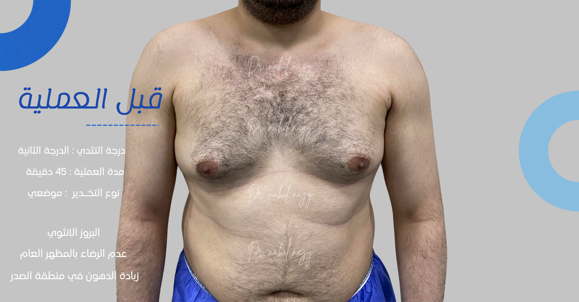 Before-حالة تثدي