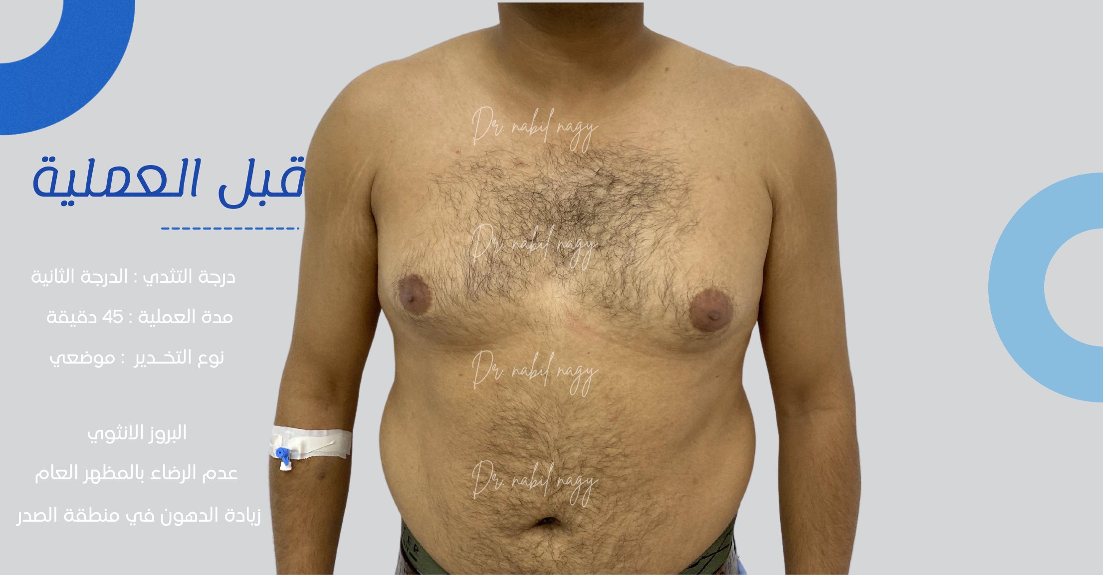 Before-حالة تثدي