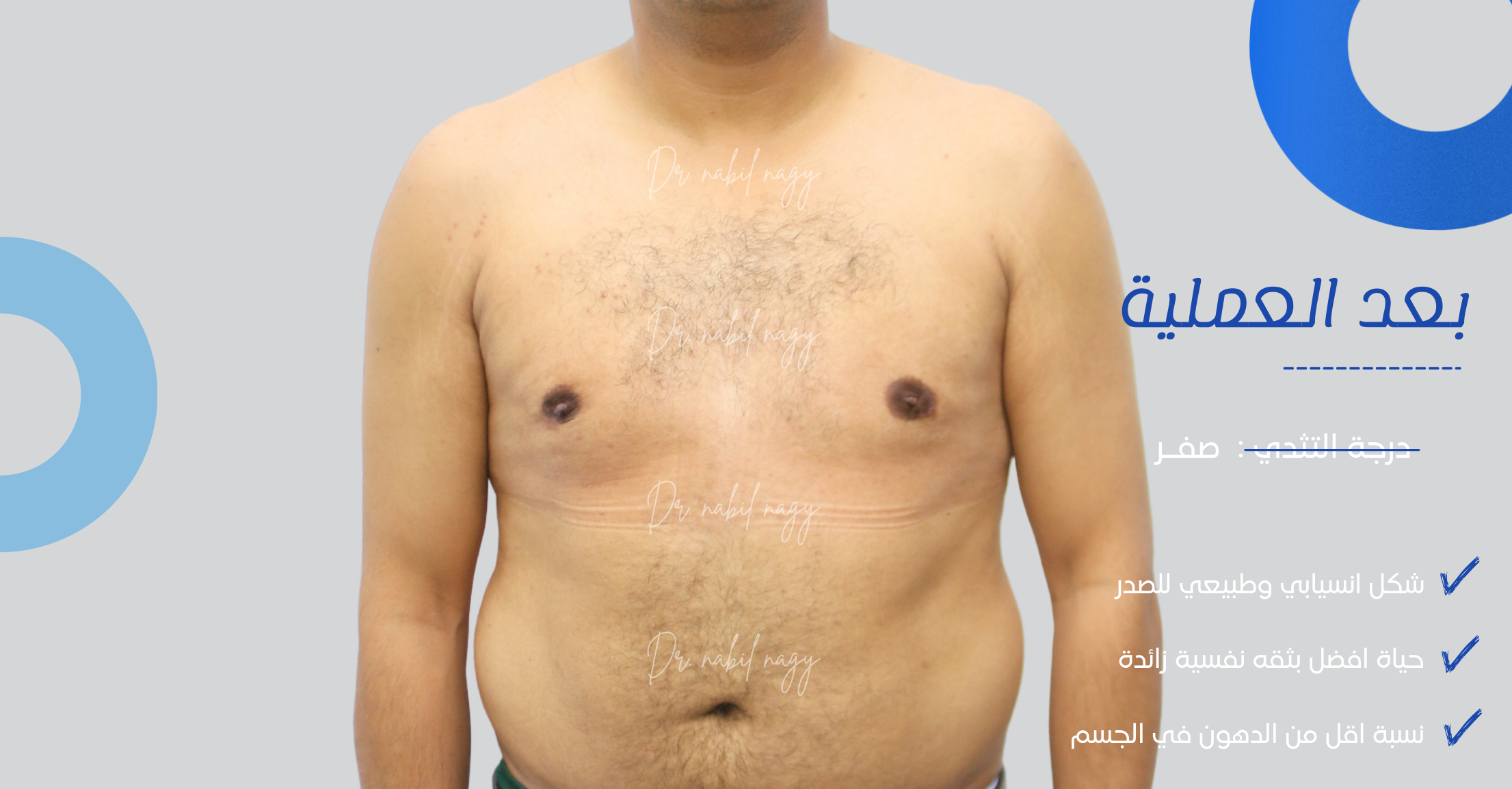 After-حالة تثدي