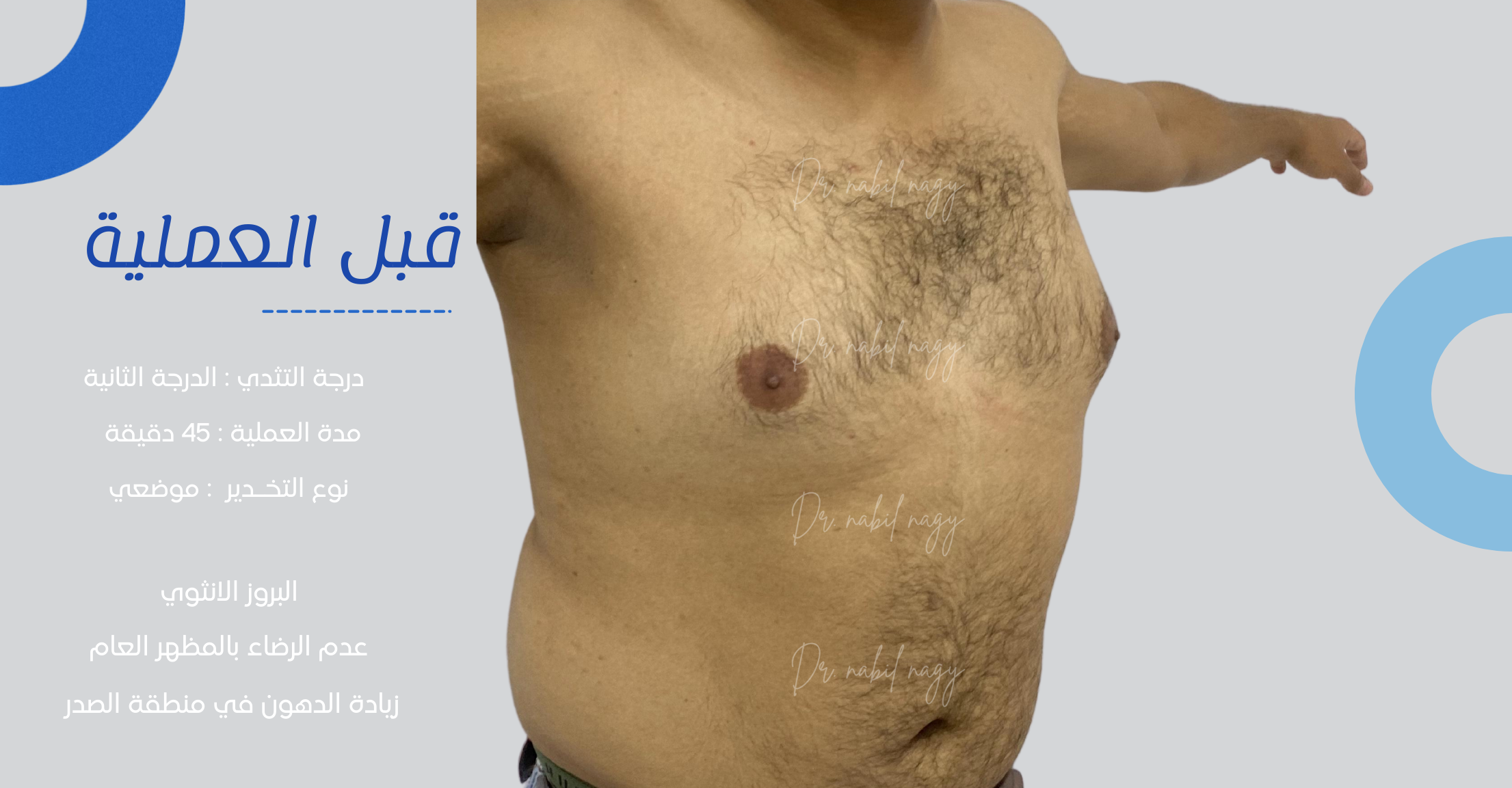 Before-حالة تثدي