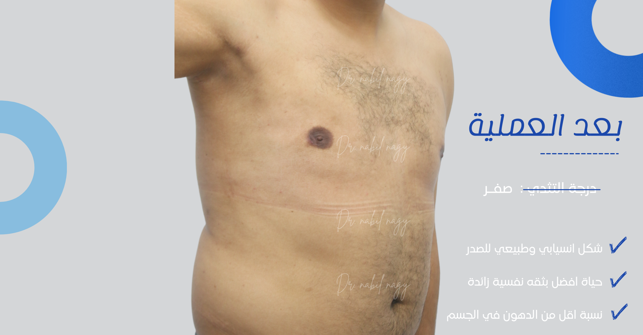 After-حالة تثدي