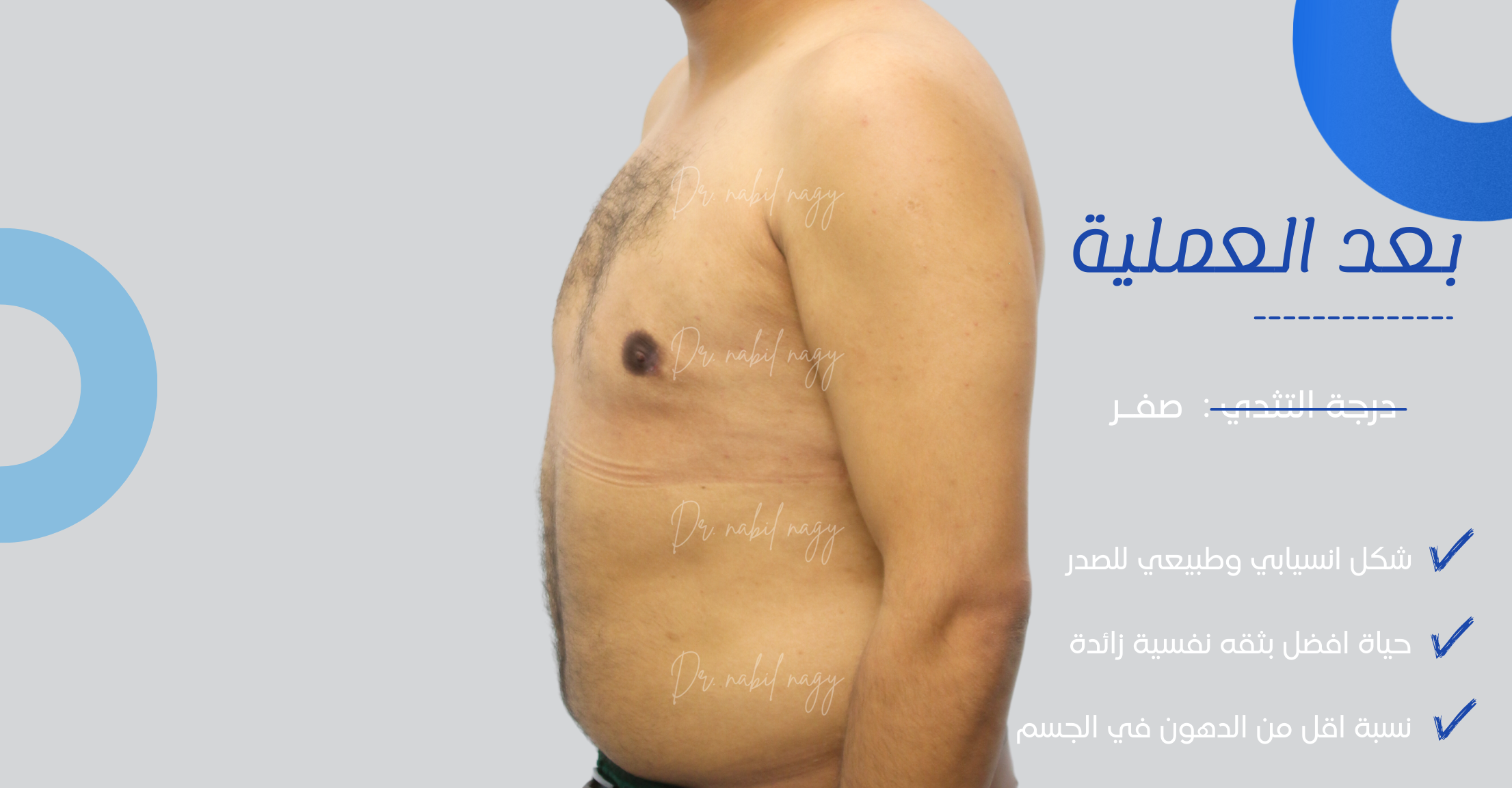 After-حالة تثدي