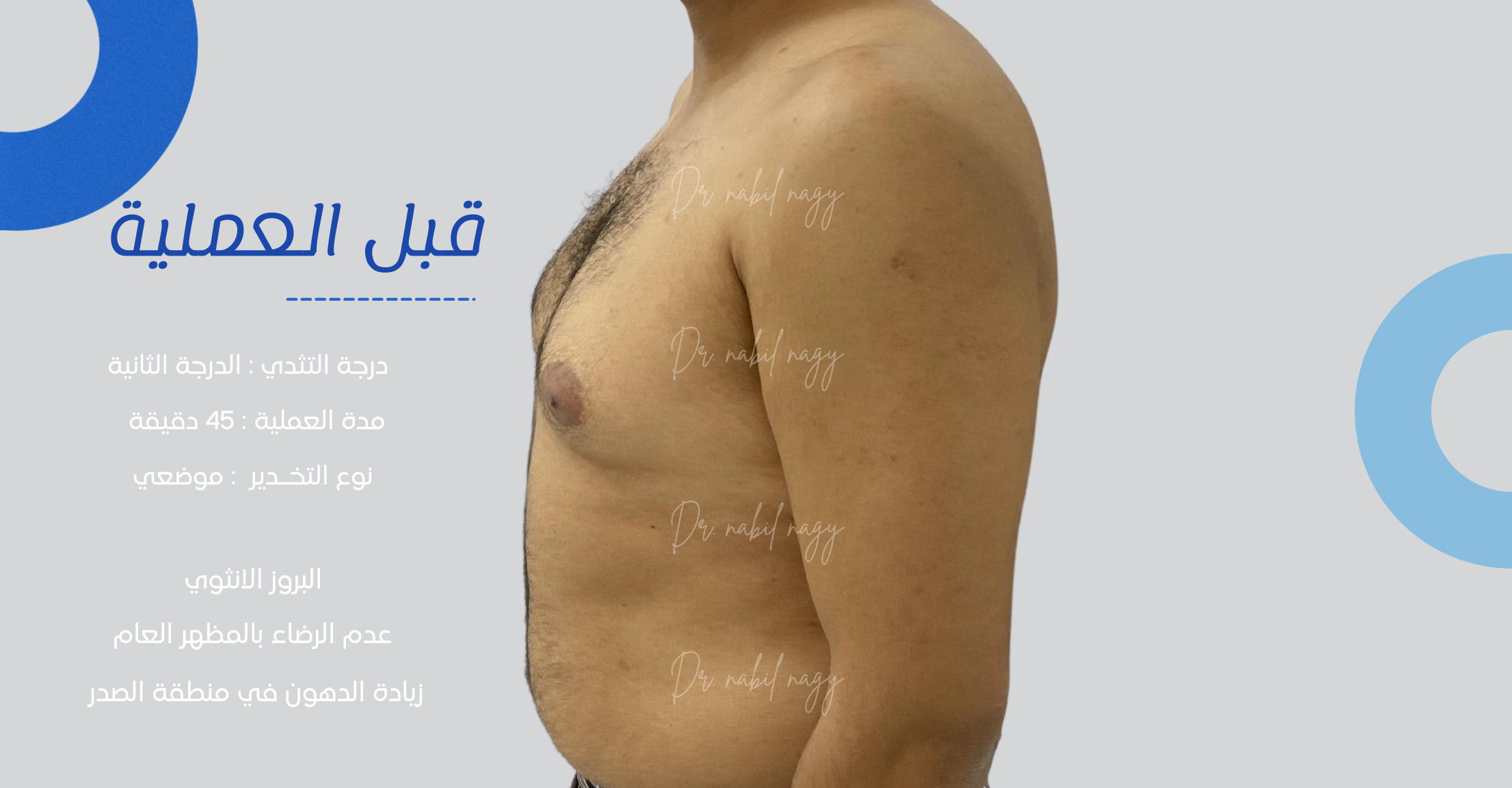 Before-حالة تثدي