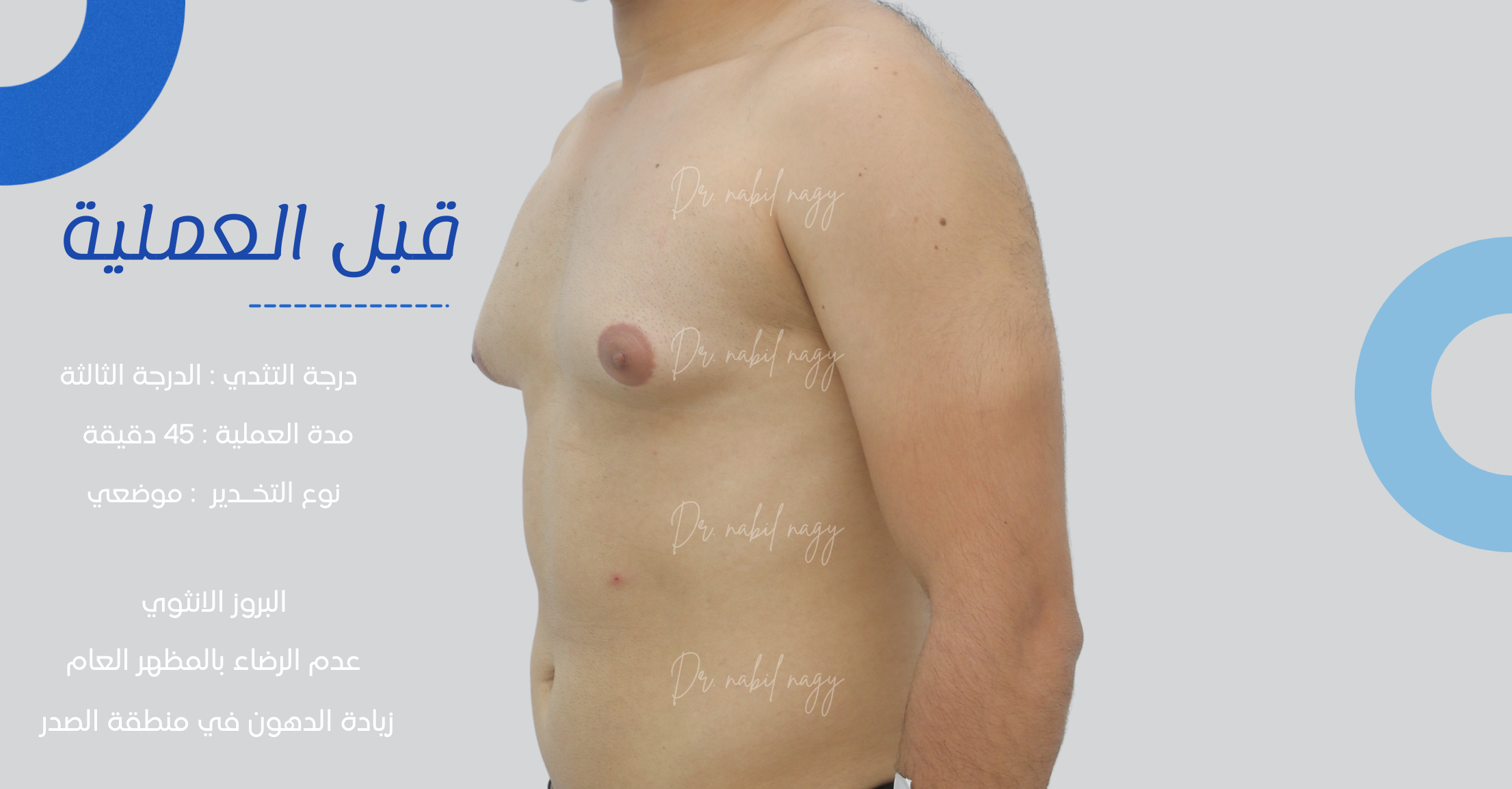 Before-حالة تثدي