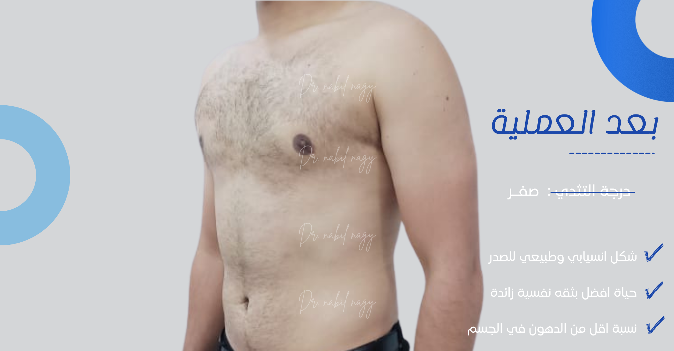 After-حالة تثدي