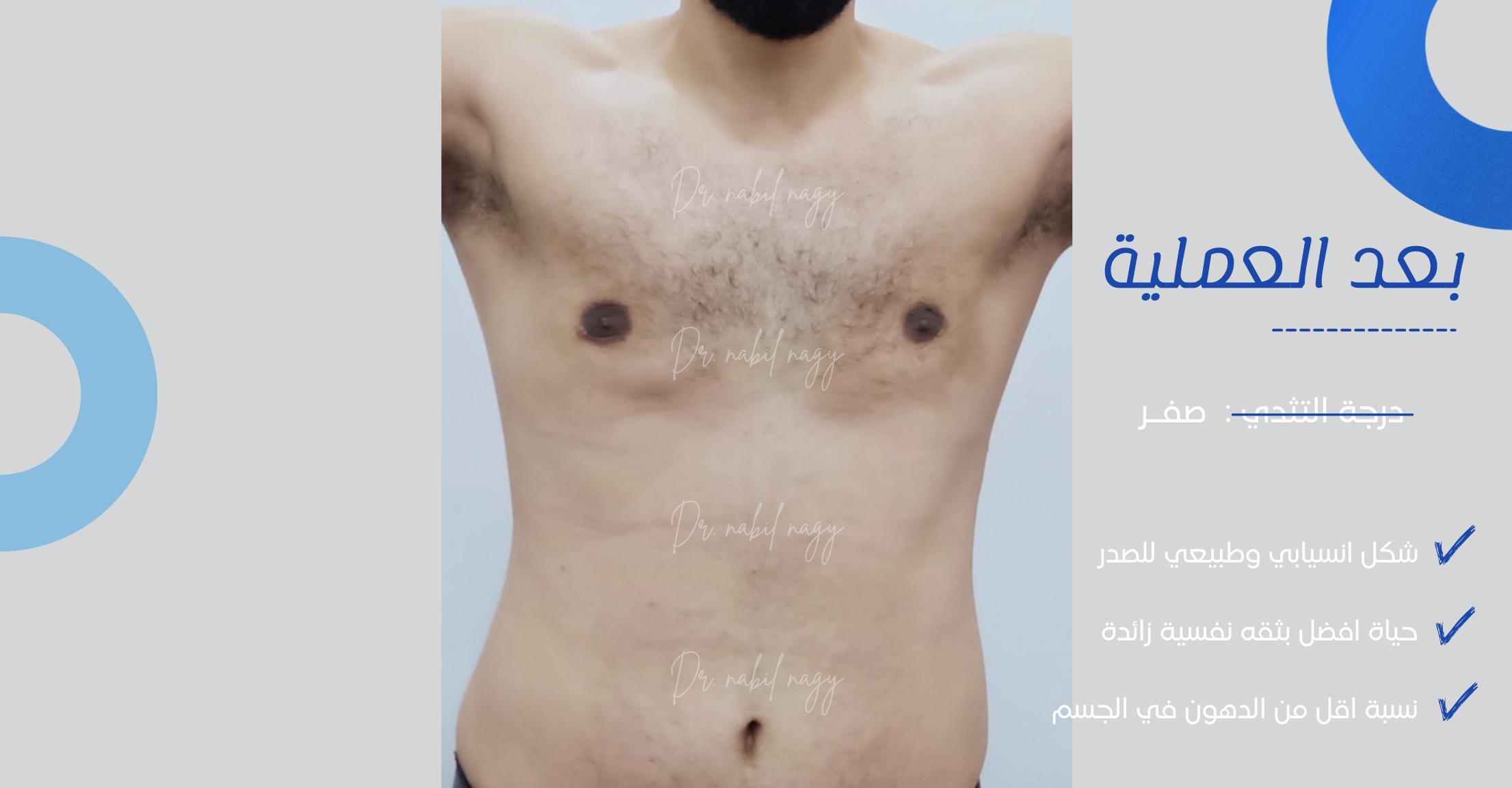After-حالة تثدي