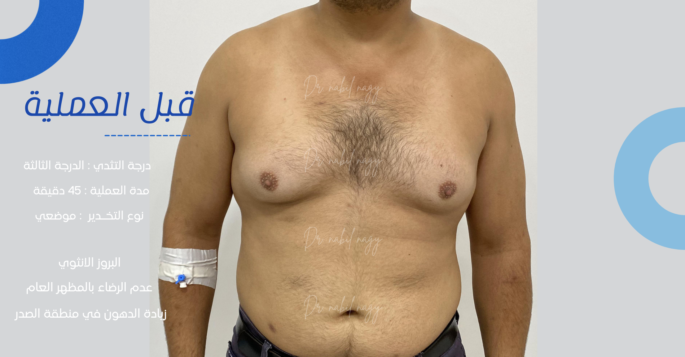 Before-حالة تثدي