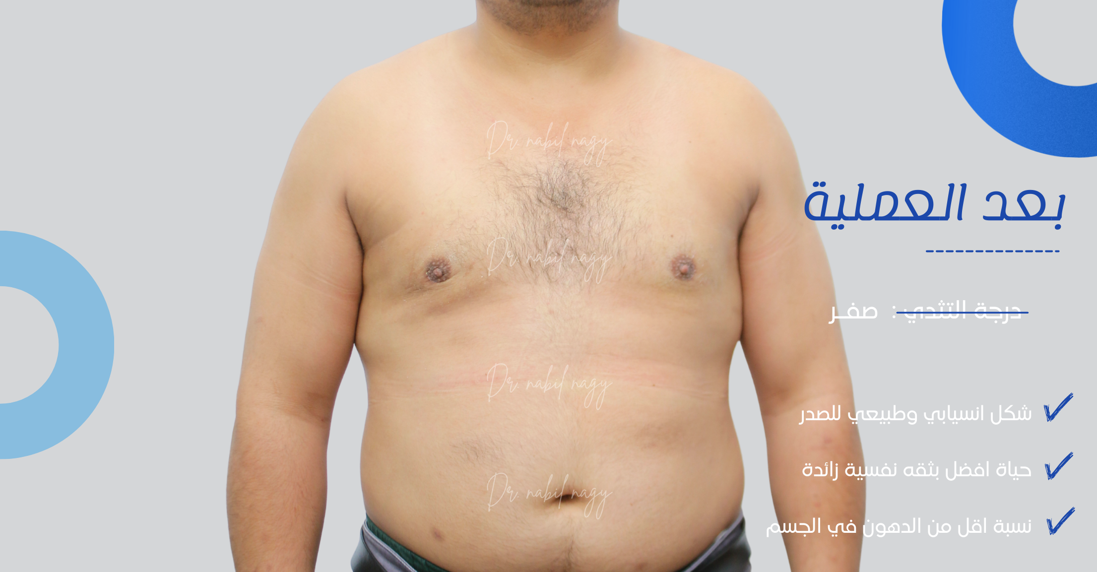 After-حالة تثدي