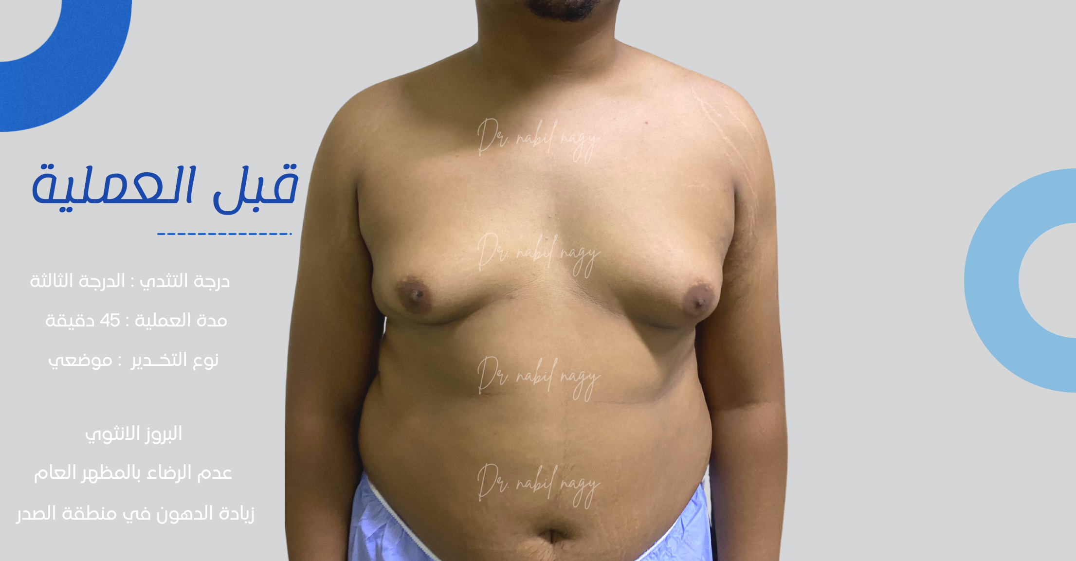 Before-حالة تثدي