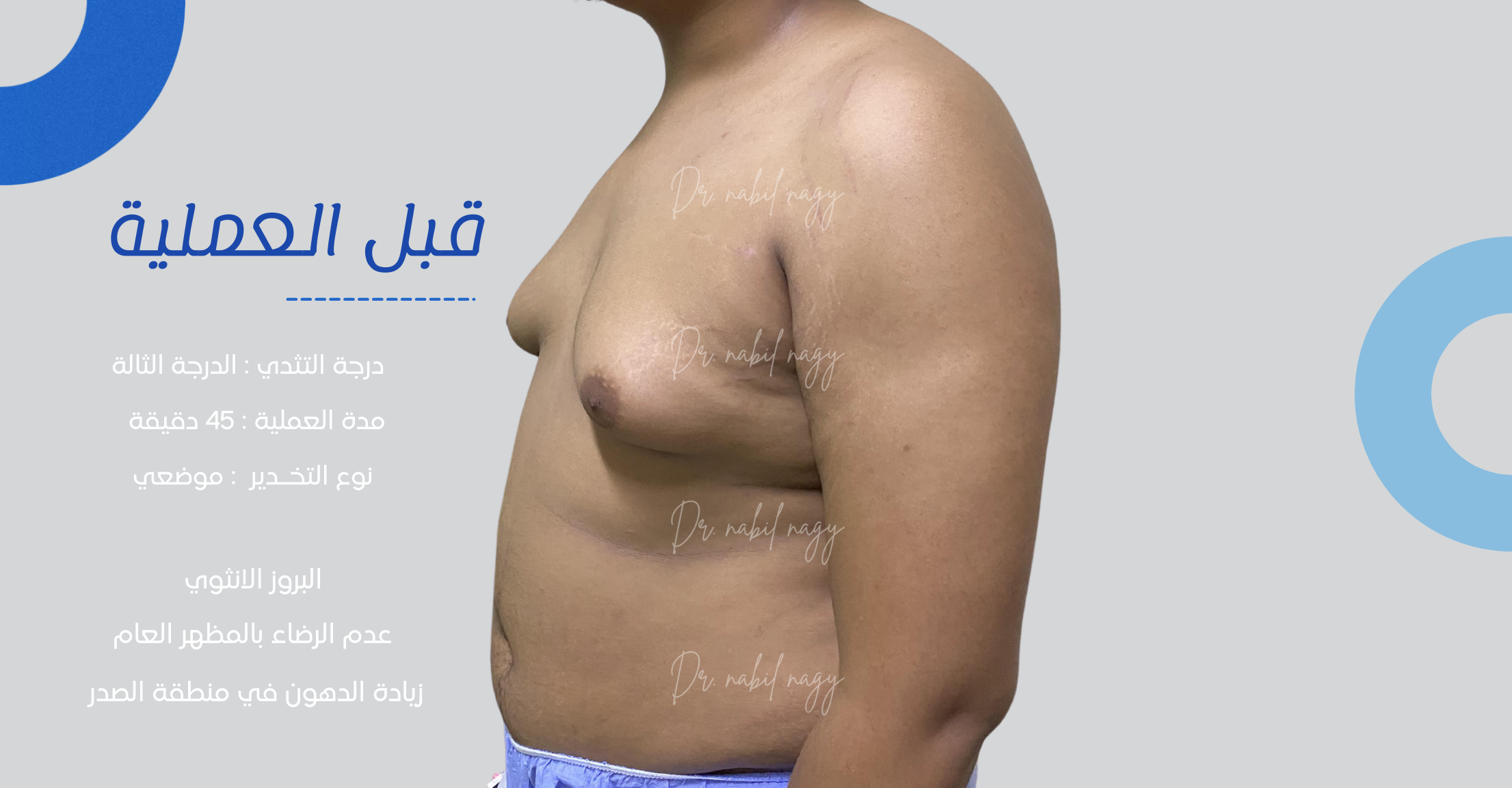 Before-حالة تثدي