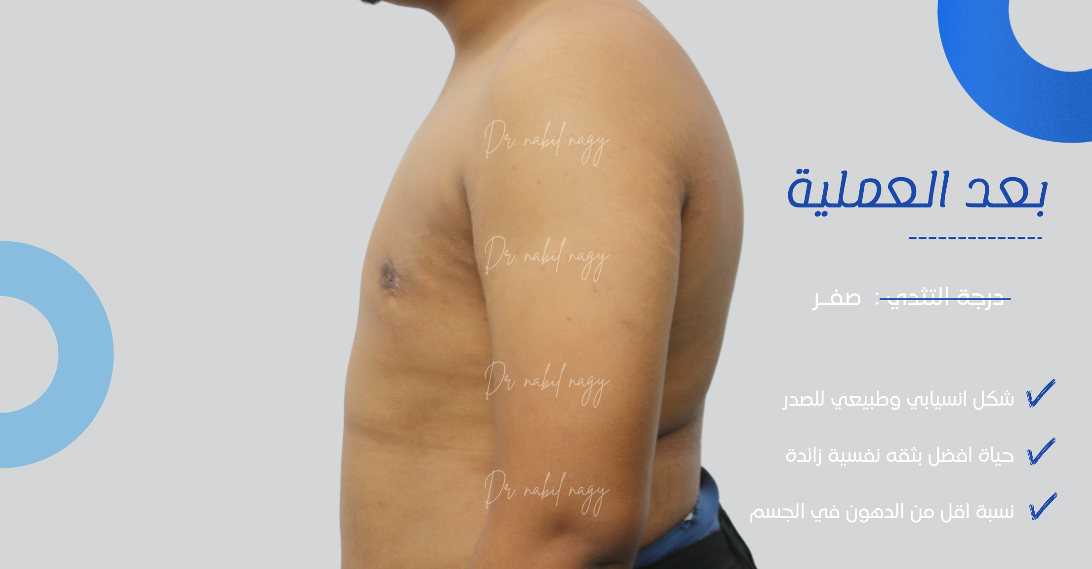After-حالة تثدي