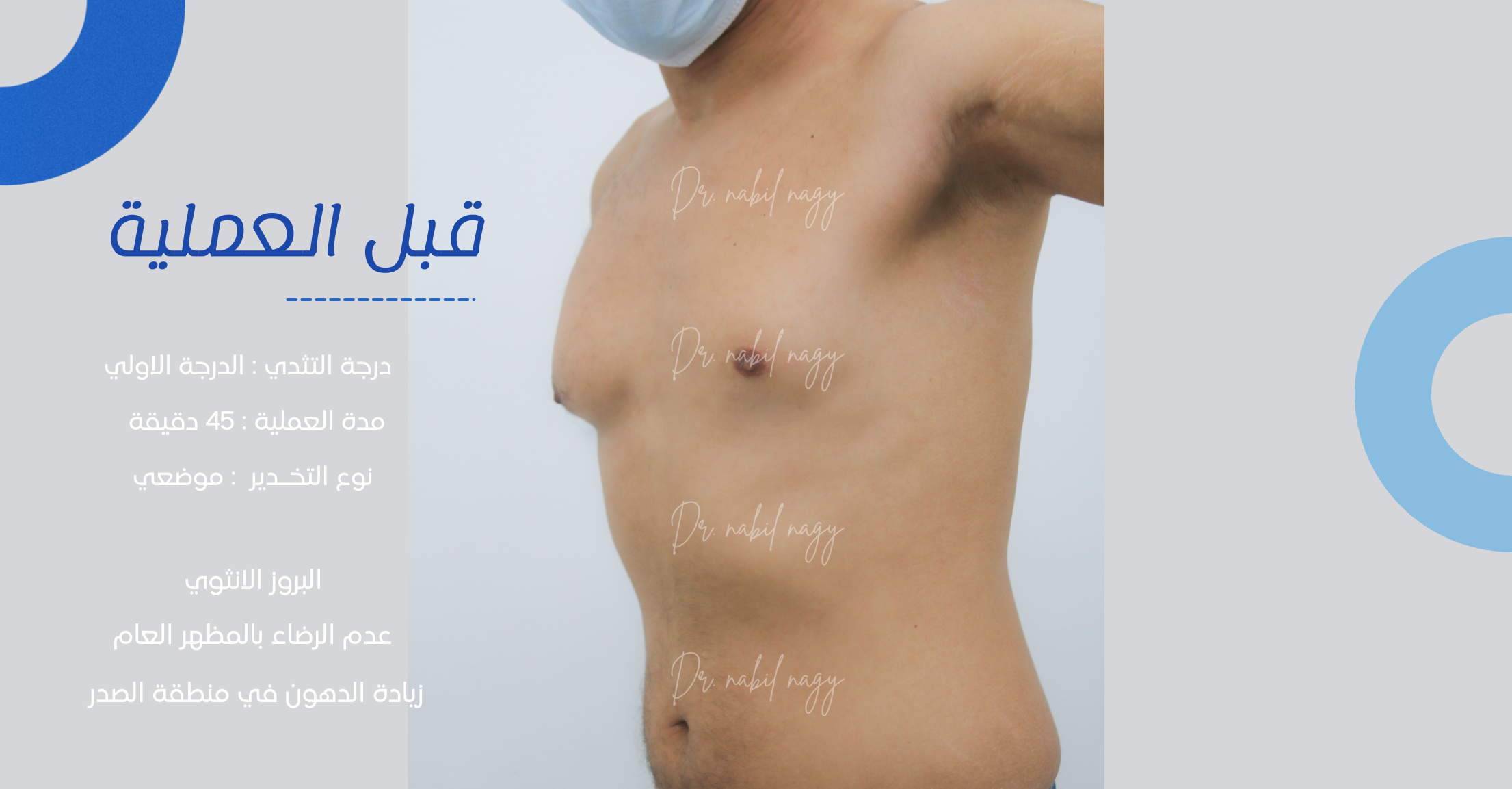 Before-حالة تثدي