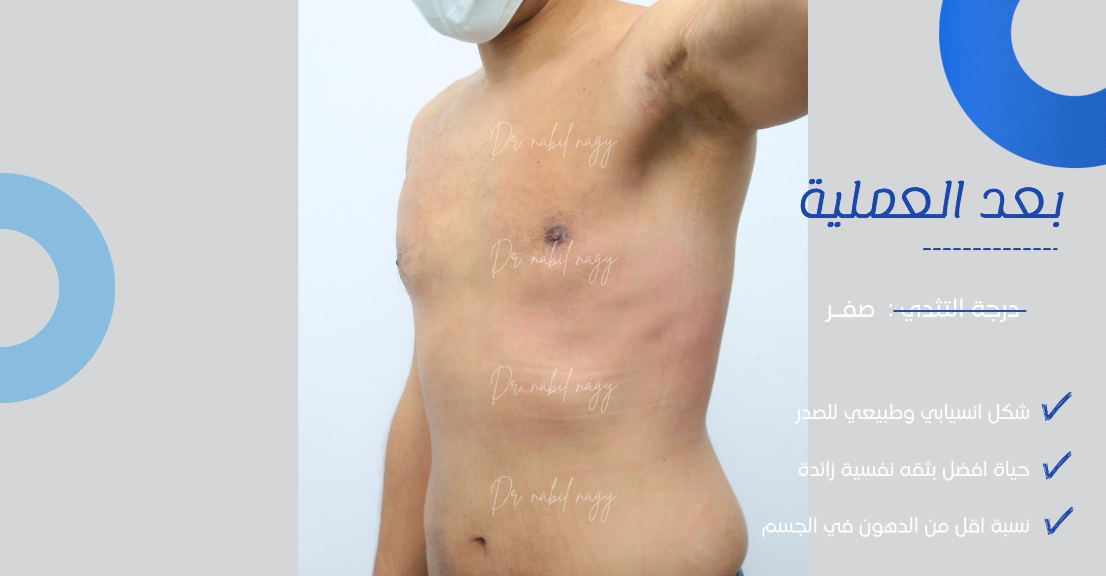 After-حالة تثدي