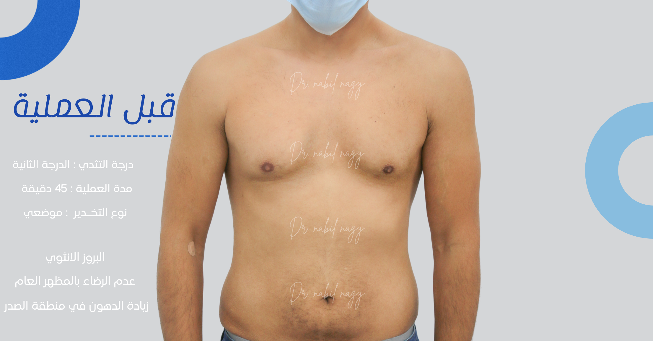 Before-حالة تثدي