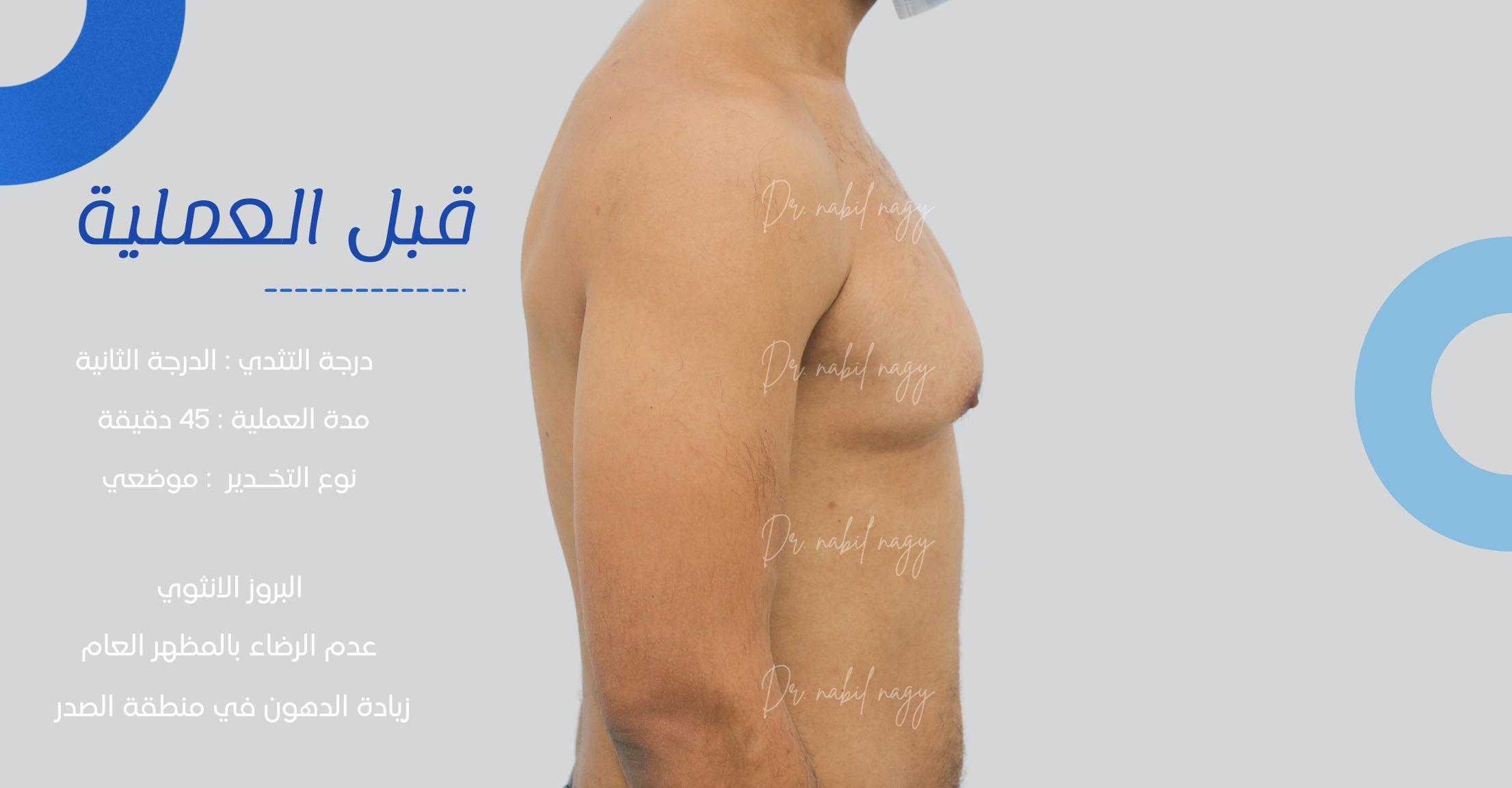 Before-حالة تثدي