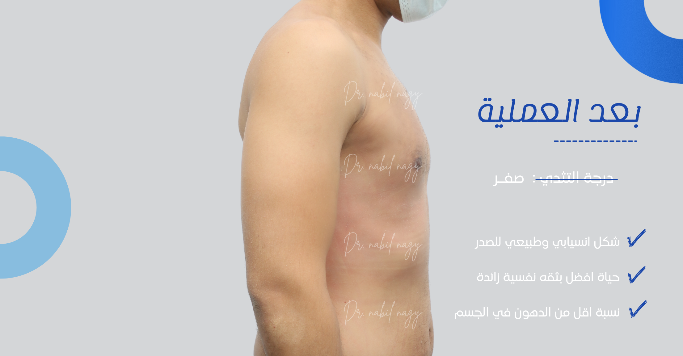 After-حالة تثدي
