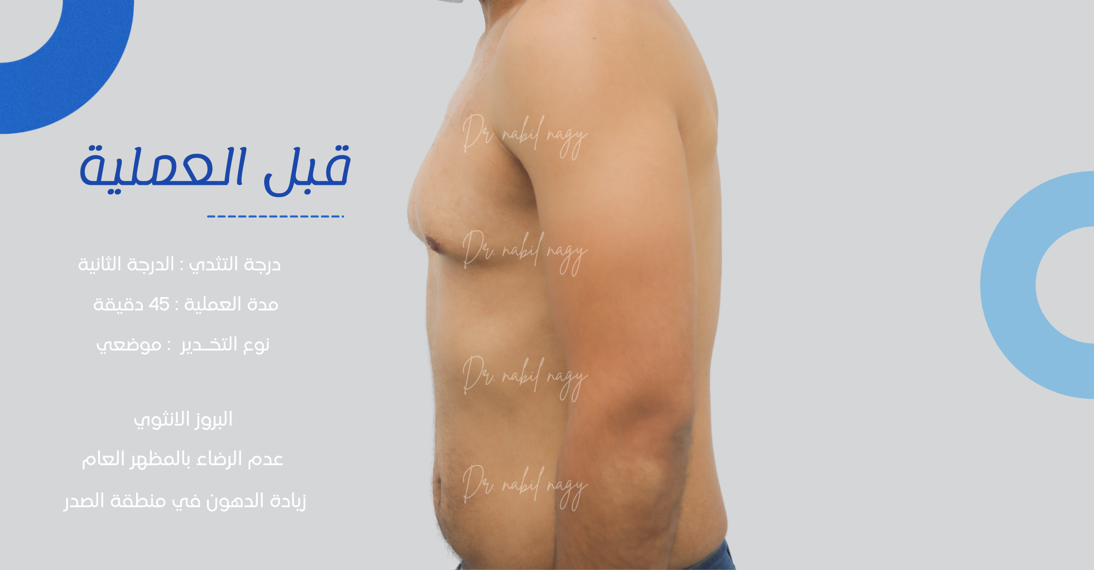 Before-حالة تثدي