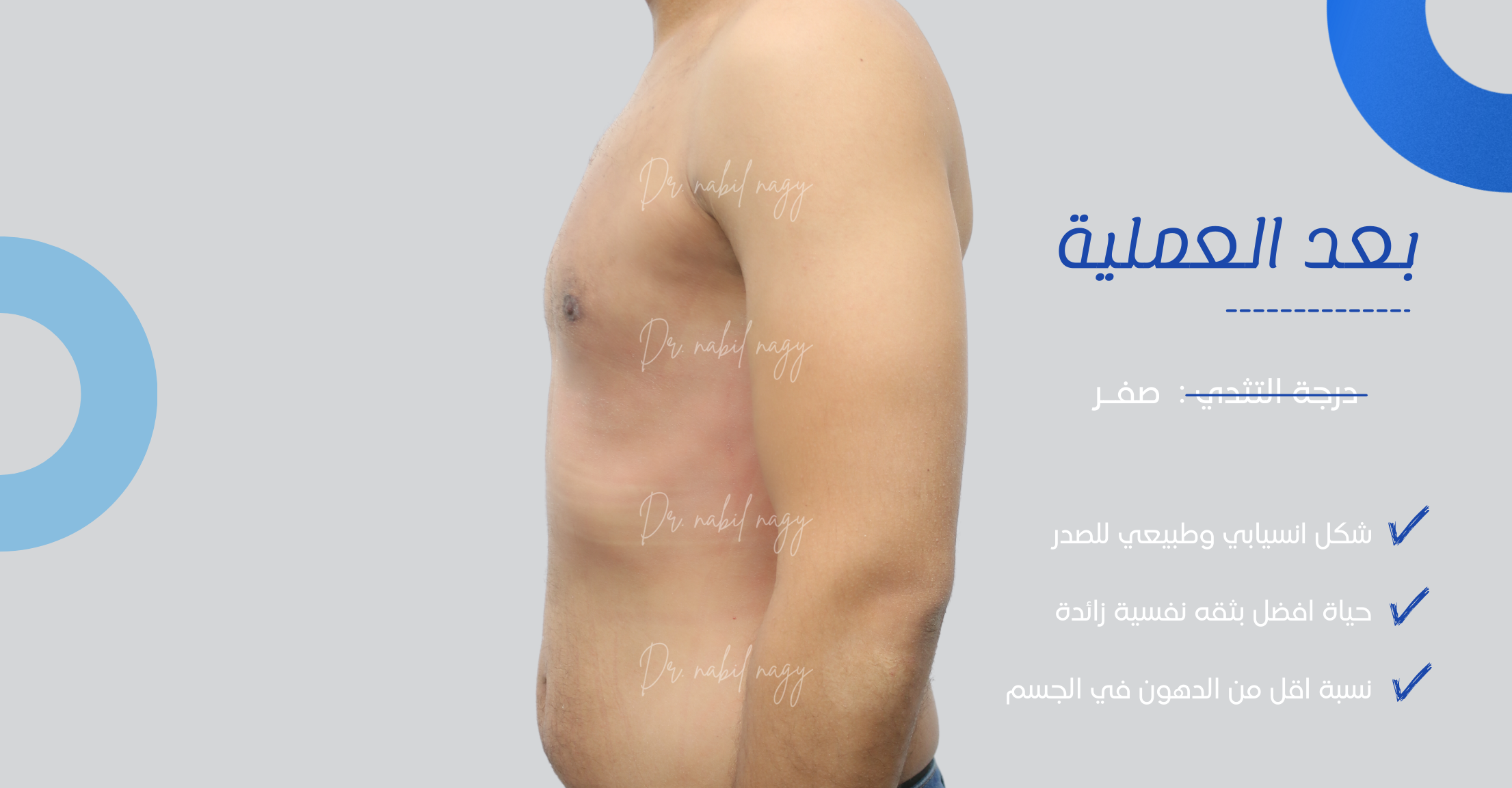 After-حالة تثدي
