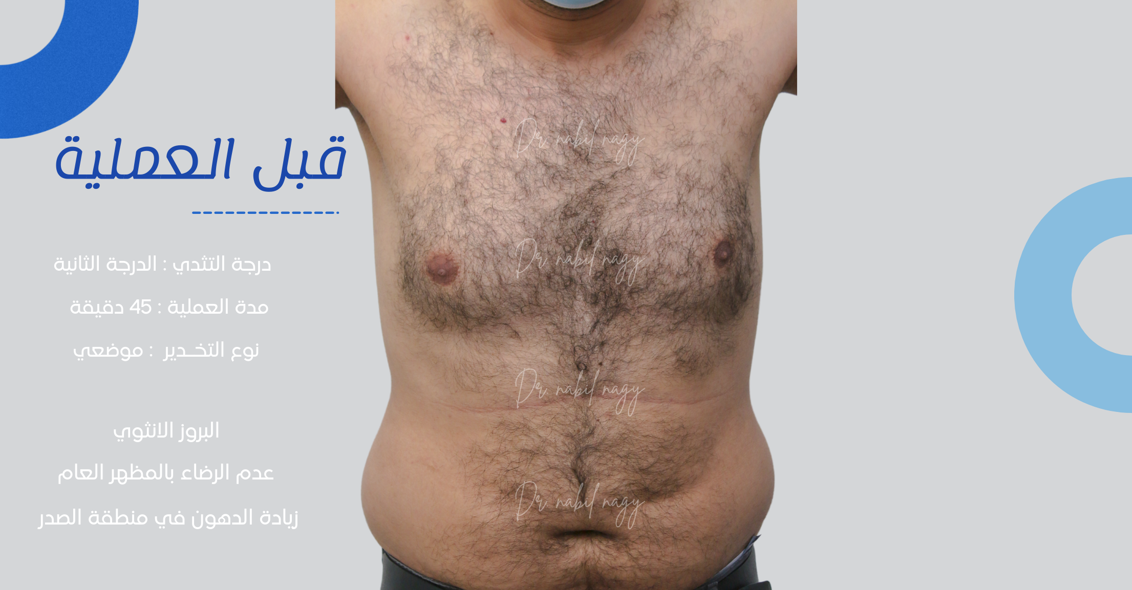 Before-حالة تثدي