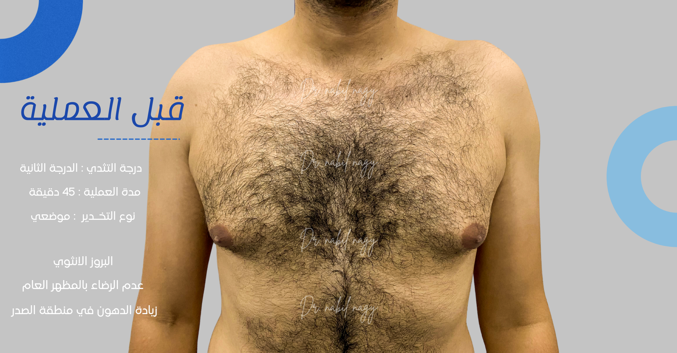 Before-حالة تثدي